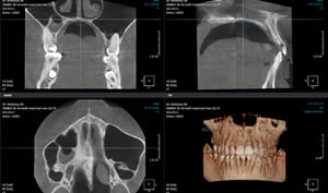 Verlagerter bzw. impaktierter / retinierter Zahn